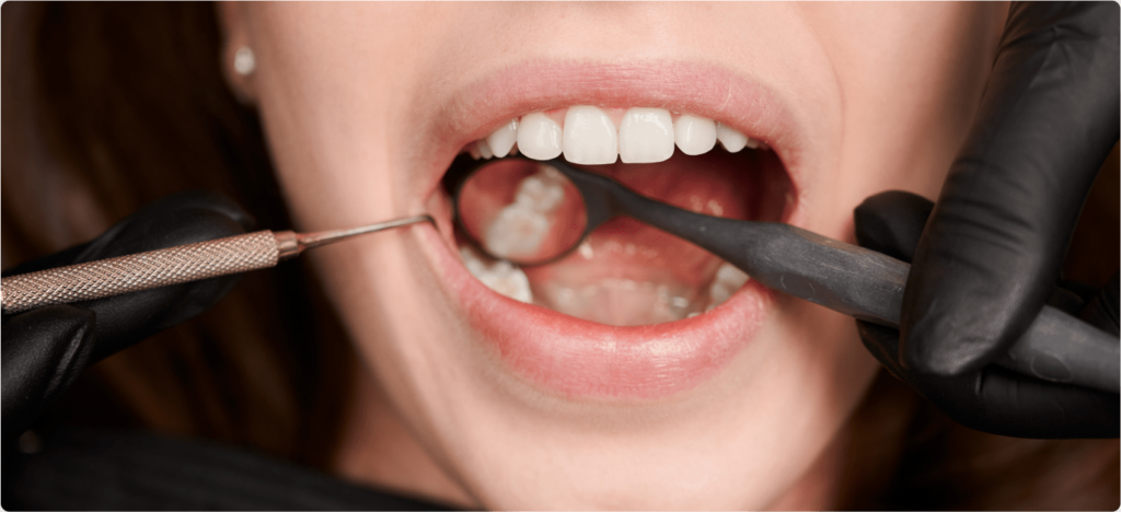 Crown Teeth Treatement in Deakin